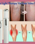 Blue Light Therapy Acne Laser Pen