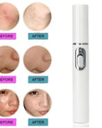 Blue Light Therapy Acne Laser Pen