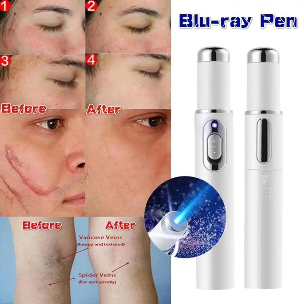 Blue Light Therapy Acne Laser Pen